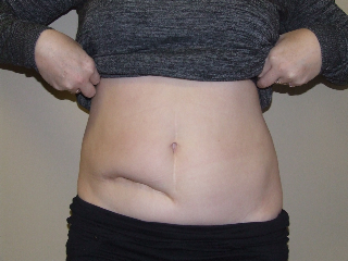 Can Tummy Tuck Surgery be Covered by Insurance? - George P
