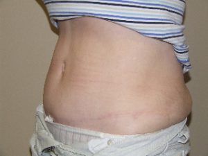 tummy tuck surgery in barrie