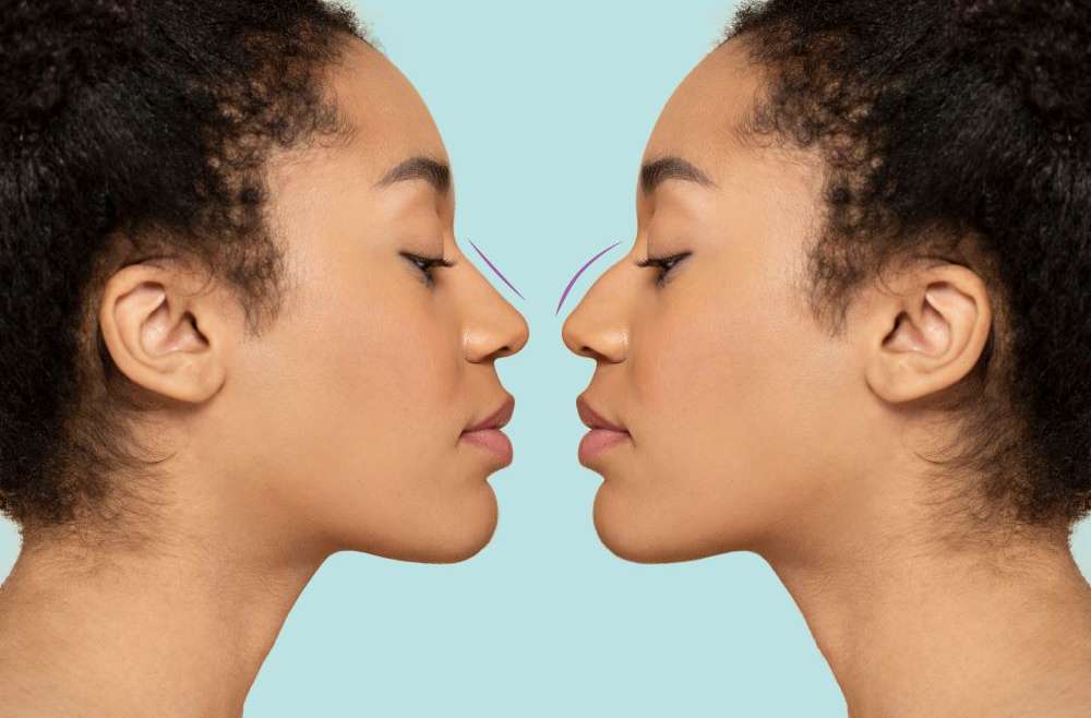 14 Common Misconceptions About Rhinoplasty