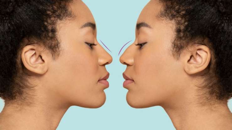 14 Common Misconceptions About Rhinoplasty
