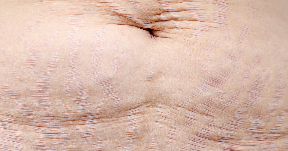 5 Misconceptions About Plastic Surgery for Stretch Marks