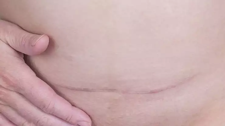 Thinking of C-Section Scar Removal? Here’s What You Need to Know