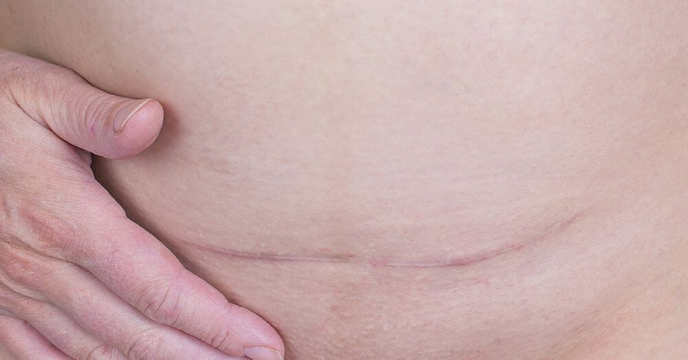 Thinking of C-Section Scar Removal? Here’s What You Need to Know