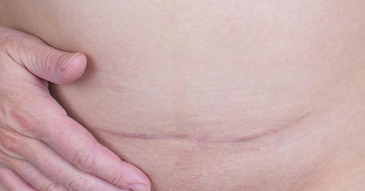 Here is what you need to know about C-section scar removal