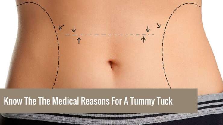 Know The Medical Reasons For A Tummy Tuck