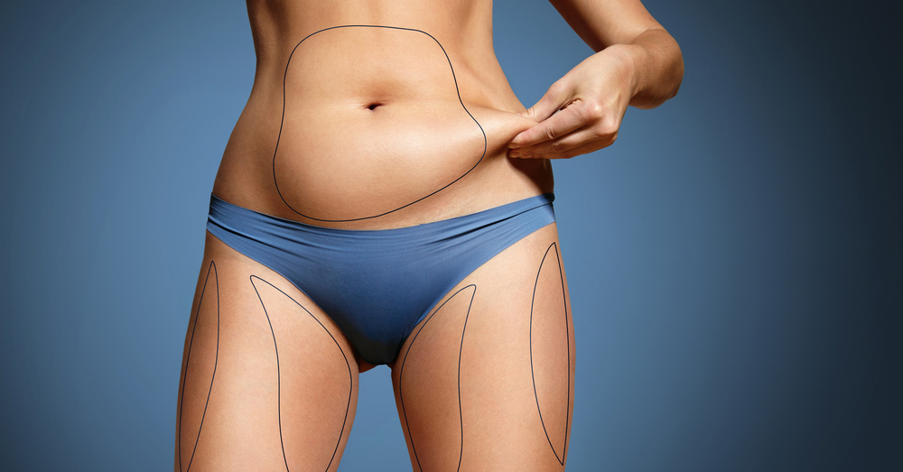 Liposuction Cost in Canada – How much does Liposuction cost in Ontario? [2024 Updated]