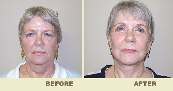 See These Happy Plastic Surgery Patients, Before and After!