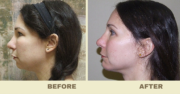 facial-implant-before-and-after