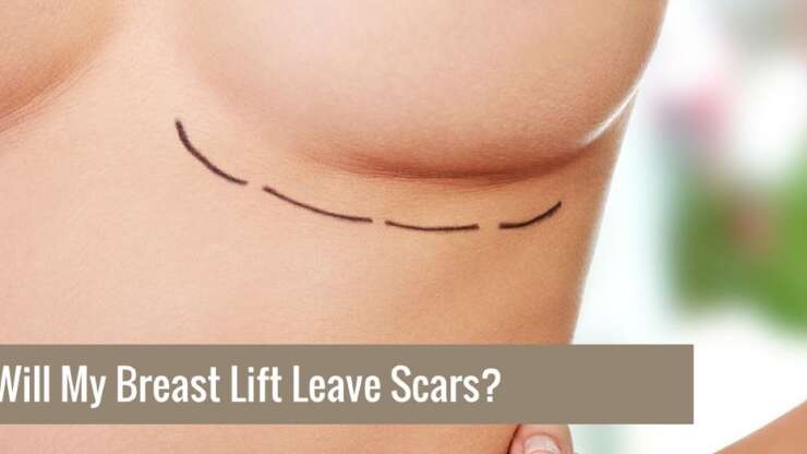 Breast Lift Scars: What to Expect