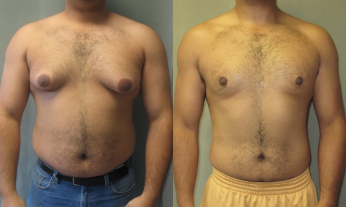 A before and after example of successful male breast reduction surgery.
