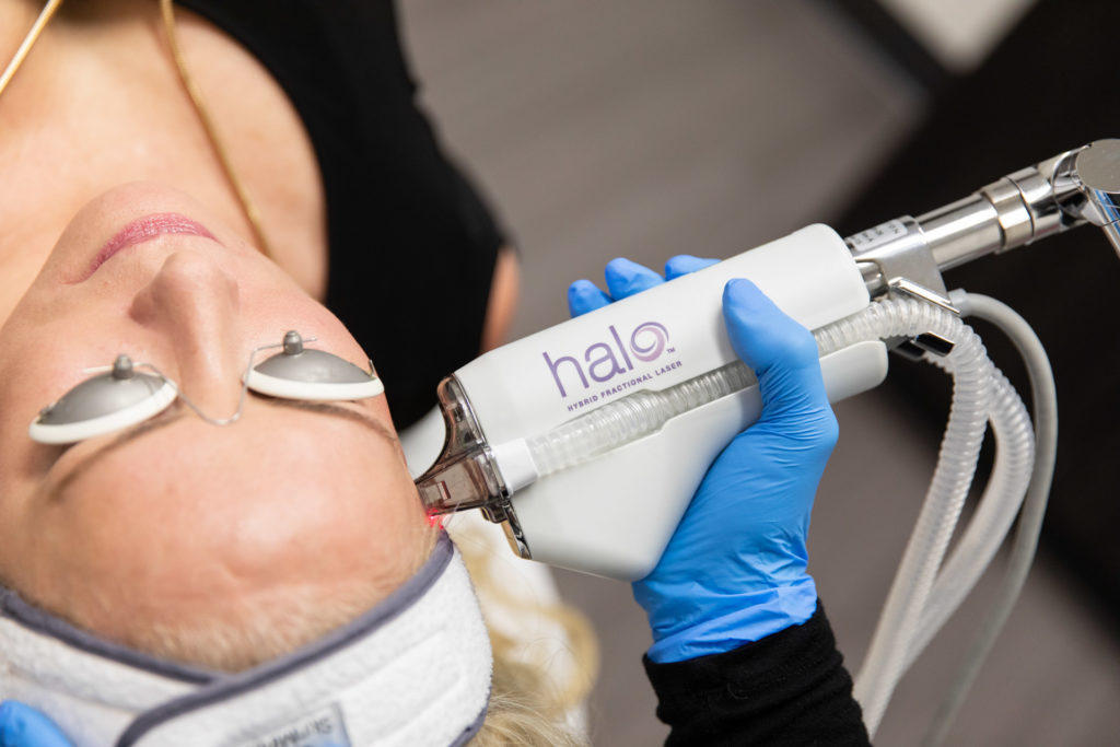 HALO Laser Skin Resurfacing