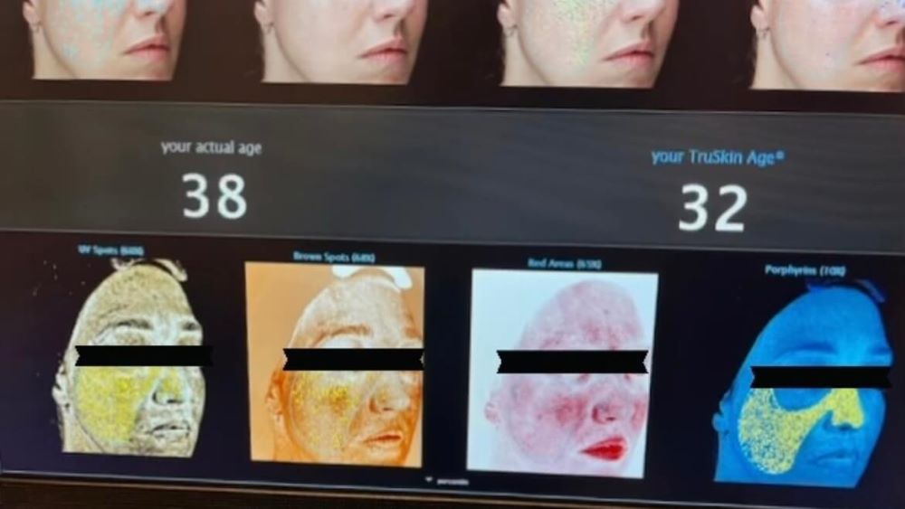 Visisa skin analysis after HALO treatment