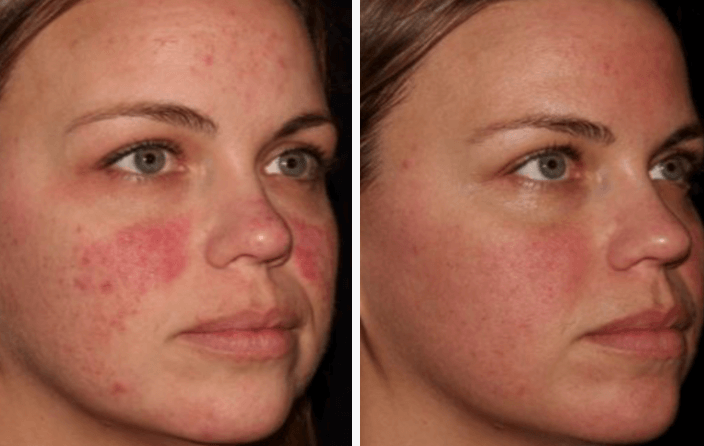 HALO laser before and after. Real results, courtesy of Sciton