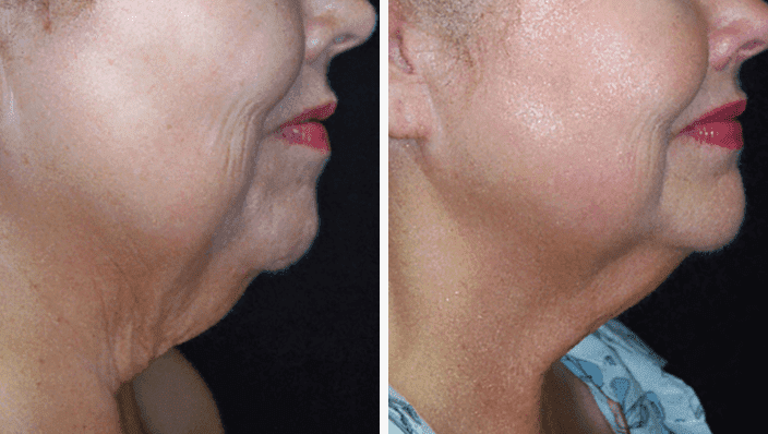 HALO laser before and after image of tightened skin. Courtesy of Sciton
