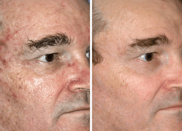 HALO laser before and after image of disappeared age spots. Courtesy of Sciton