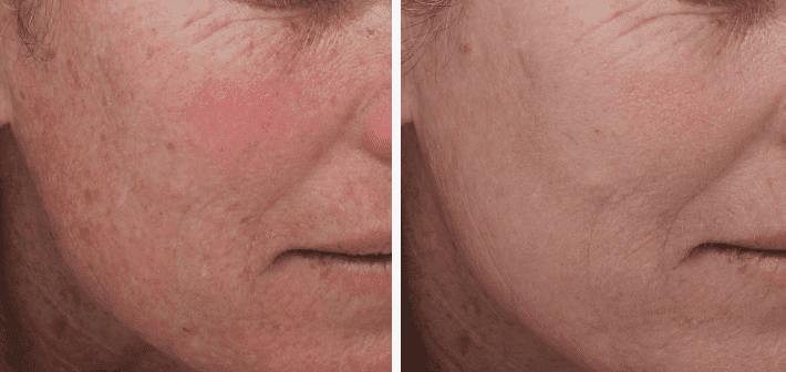 HALO laser before and after. Real results, courtesy of Sciton