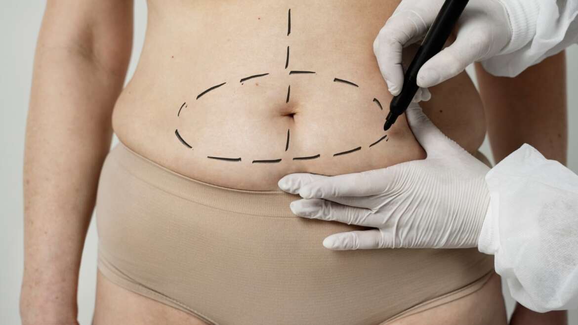 Tummy Tuck Financing: Practical Ways to Afford Your Dream Transformation