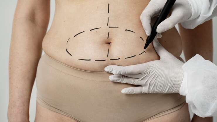 Tummy Tuck Financing: Practical Ways to Afford Your Dream Transformation