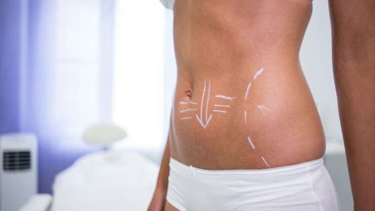 Abdominoplasty Cost in Ontario: Prices, Insurance & Payment Plans